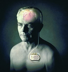 estimulacion cerebral profunda