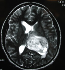 glioblastoma multiforme