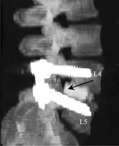 artrodesis lumbar