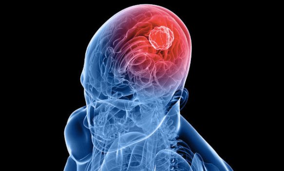Resultado de imagen de glioblastoma